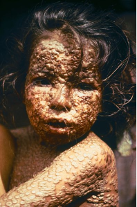 bangladeshi smallpox
